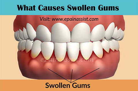 Causes and treatments for gum swelling - San Jose Dental Health Care San Jo...